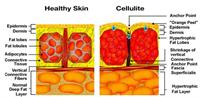 How to prevent cellulite?